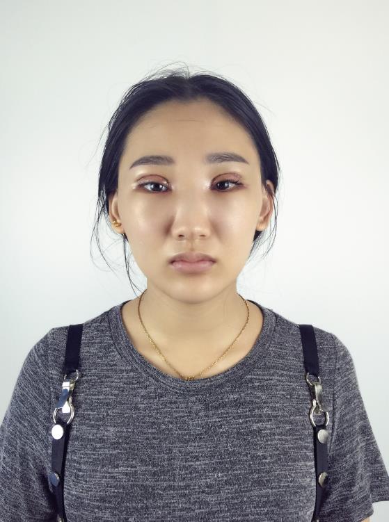 武漢中翰整形外科醫(yī)院沈磊醫(yī)生做切開雙眼皮怎么樣？附沈磊切開雙眼皮案例