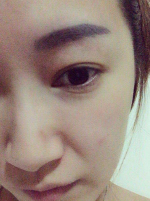 重慶五洲女子醫(yī)院整形美容中心做光子嫩膚怎么樣？淡明斌醫(yī)生光子嫩膚案例