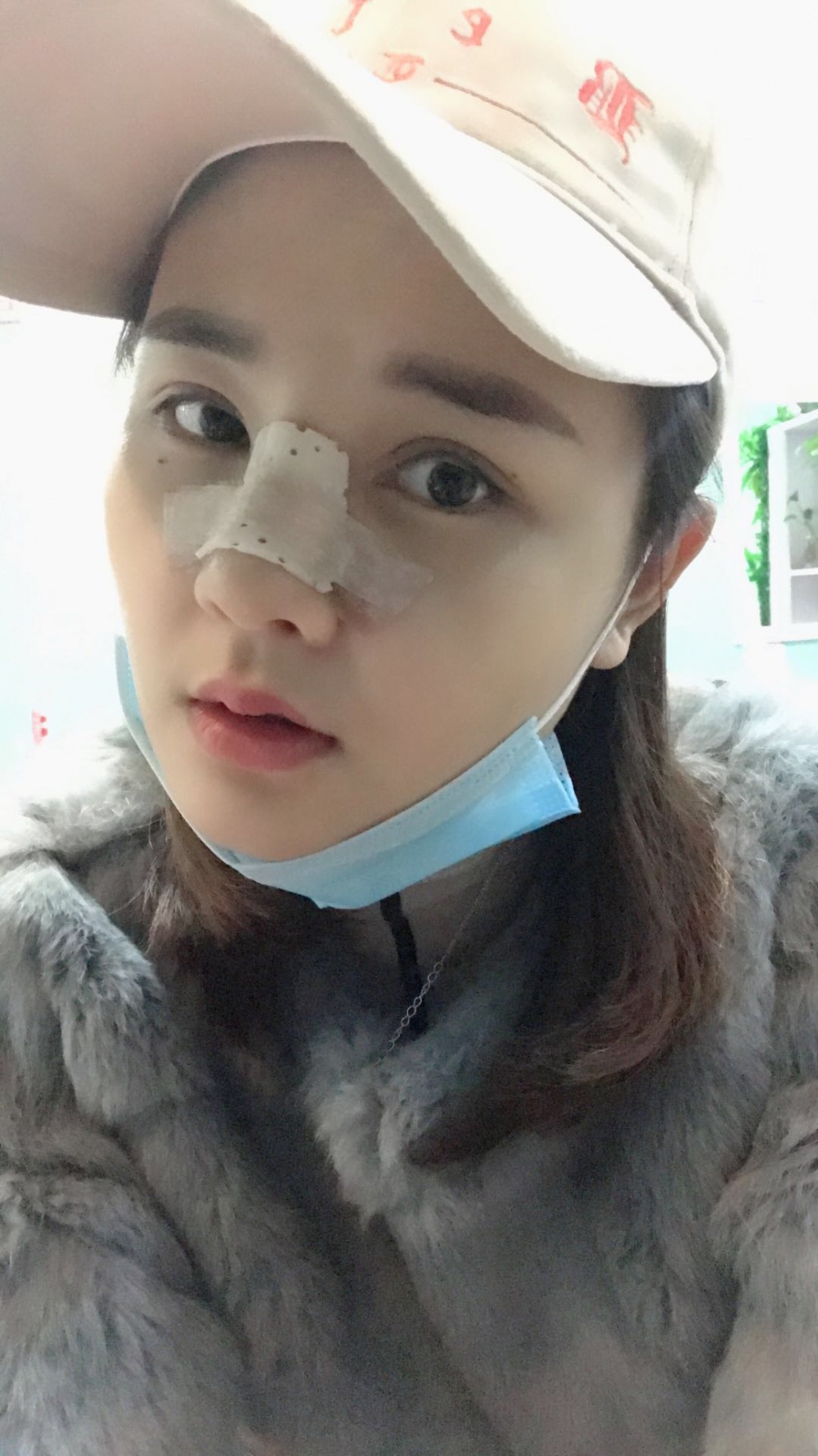 鄭州華領(lǐng)醫(yī)療美容醫(yī)院賀小虎醫(yī)生做眼綜合+鼻部整形手術(shù)效果怎么樣？