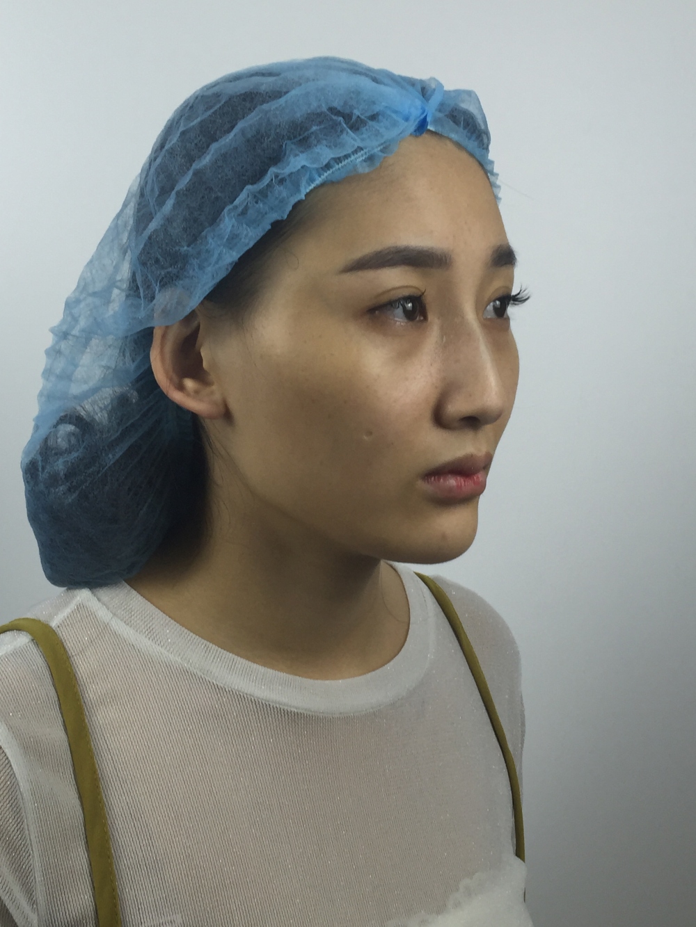 武漢中翰整形外科醫(yī)院沈磊醫(yī)生做切開雙眼皮怎么樣？附沈磊切開雙眼皮案例