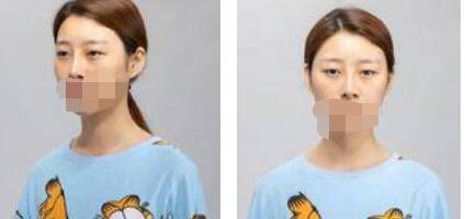 太原歐美蓮整形醫(yī)院丁曉峰醫(yī)生做雙眼皮怎么樣？丁曉峰雙眼皮手術(shù)案例分享