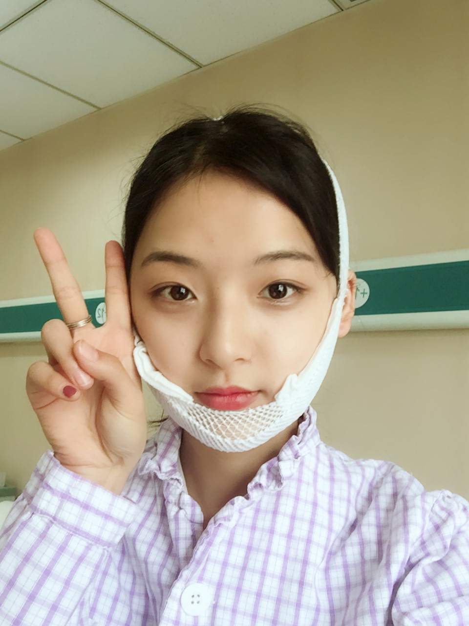 鄭州名門整形醫(yī)院董斌醫(yī)生做下頜角整形怎么樣？附下頜角整形案例