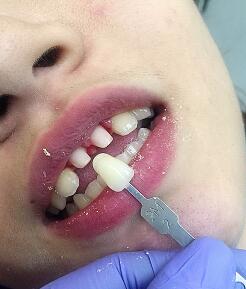 武漢康承貝健口腔醫(yī)院宋磊醫(yī)生做二氧化鋯全瓷牙效果怎么樣？附案例