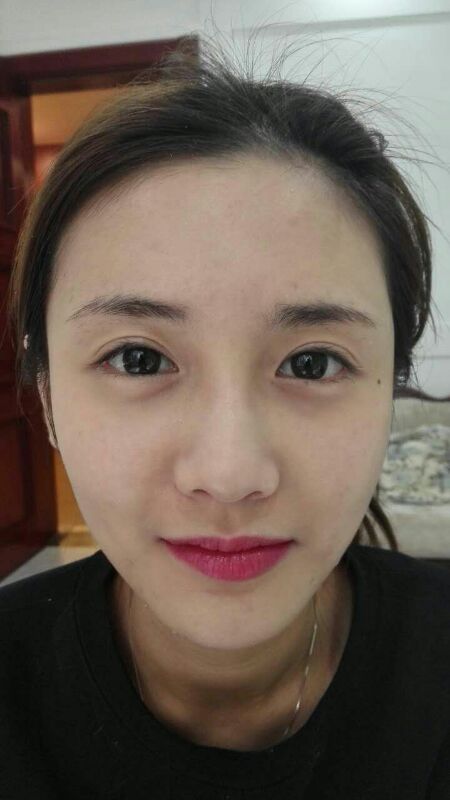 鄭州銘藝整形醫(yī)生陳濤做切開雙眼皮怎么樣？鄭州銘藝切開雙眼皮案例