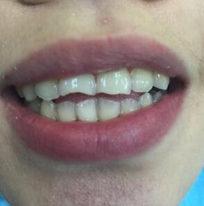 武漢康承貝健口腔醫(yī)院宋磊醫(yī)生做二氧化鋯全瓷牙效果怎么樣？附案例