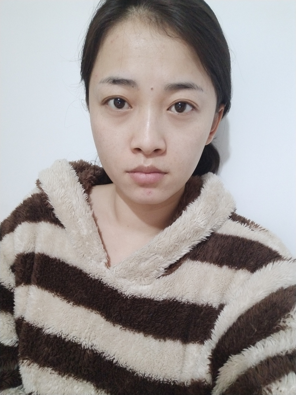 重慶當(dāng)代整形李敏旭醫(yī)生做皮秒激光祛斑效果怎么樣？附皮秒激光祛斑案例