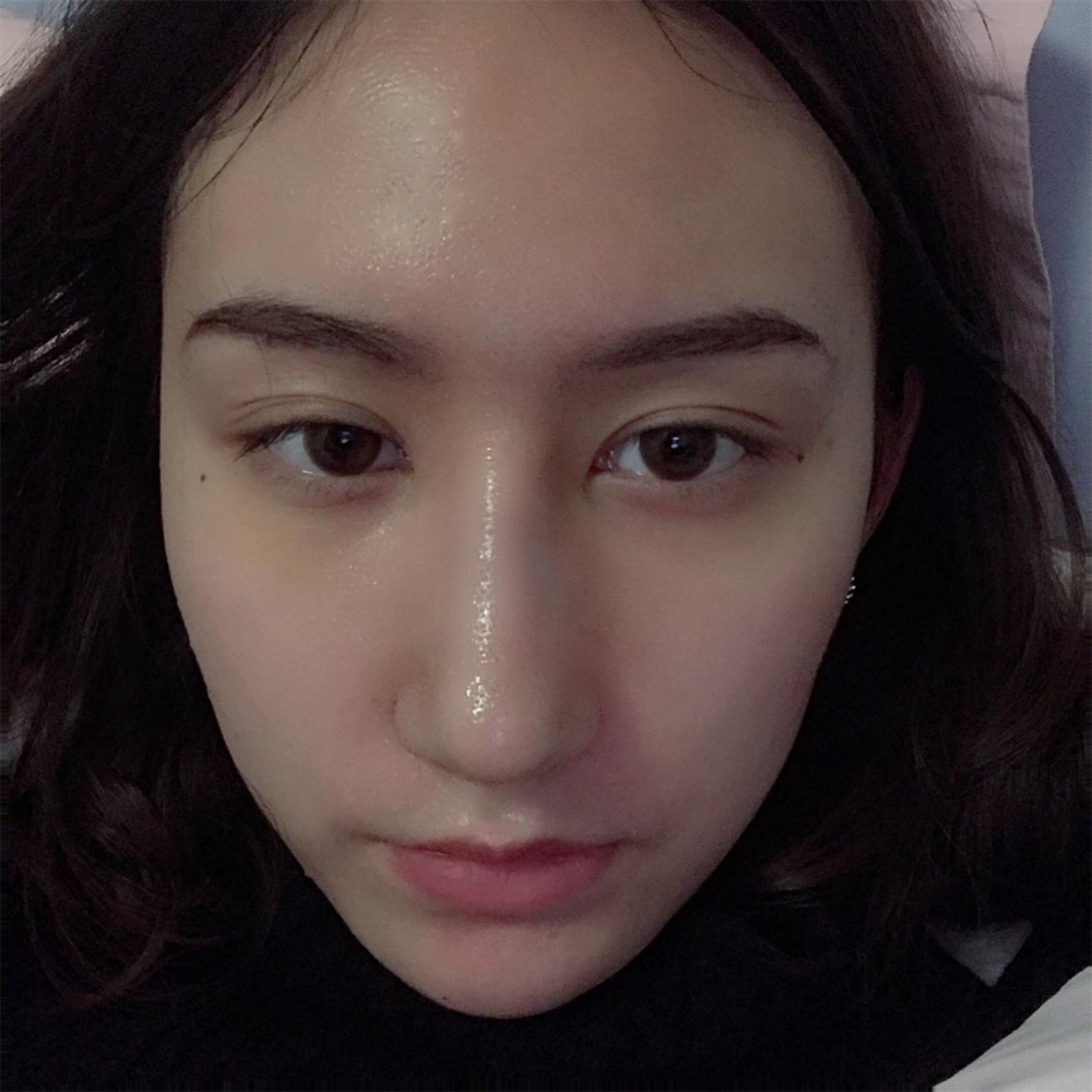 煙臺(tái)洛神醫(yī)學(xué)美容醫(yī)院張瑞允醫(yī)生做硅膠隆鼻怎么樣？附硅膠隆鼻案例