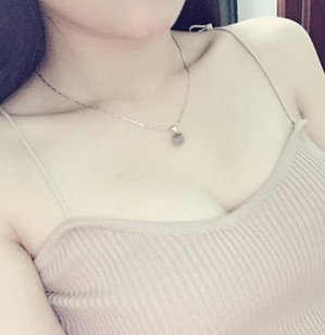 珠海萊茵醫(yī)療美容醫(yī)院崔俊溶醫(yī)生做自體脂肪隆胸效果怎么樣？附自體脂肪隆胸案例