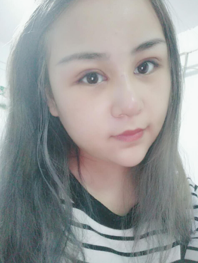 鄭州美麗時光整形醫(yī)生馬戰(zhàn)勝做雙眼皮+隆胸案例效果對比圖