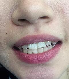 武漢康承貝健口腔醫(yī)院宋磊醫(yī)生做二氧化鋯全瓷牙效果怎么樣？附案例