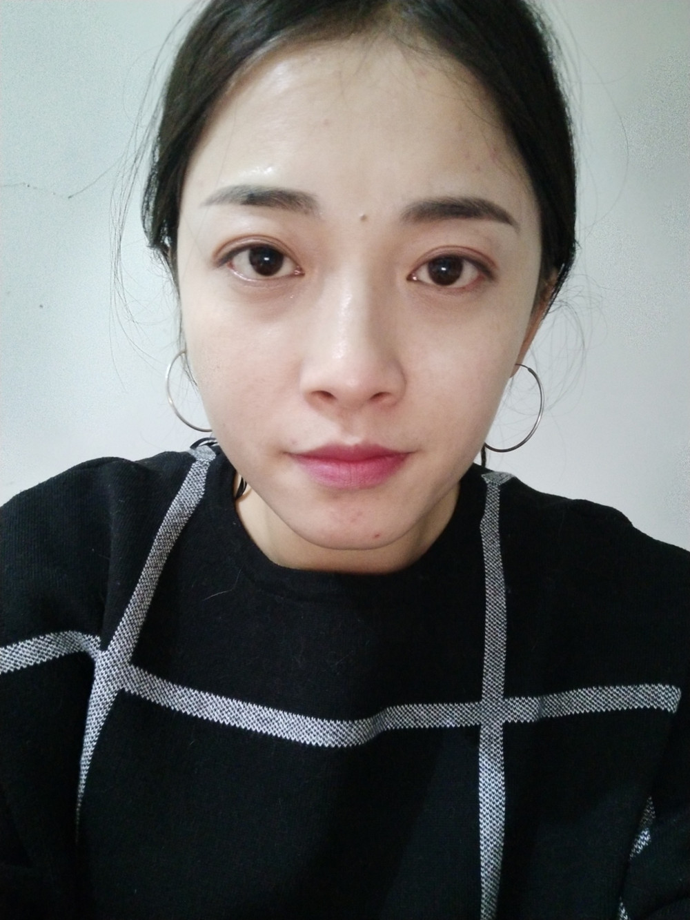 重慶當(dāng)代整形李敏旭醫(yī)生做皮秒激光祛斑效果怎么樣？附皮秒激光祛斑案例