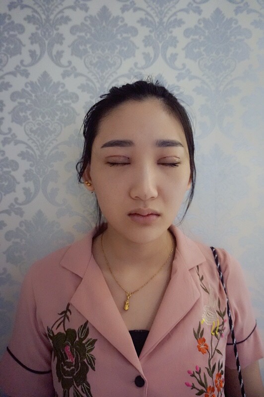 武漢中翰整形外科醫(yī)院沈磊醫(yī)生做切開雙眼皮怎么樣？附沈磊切開雙眼皮案例