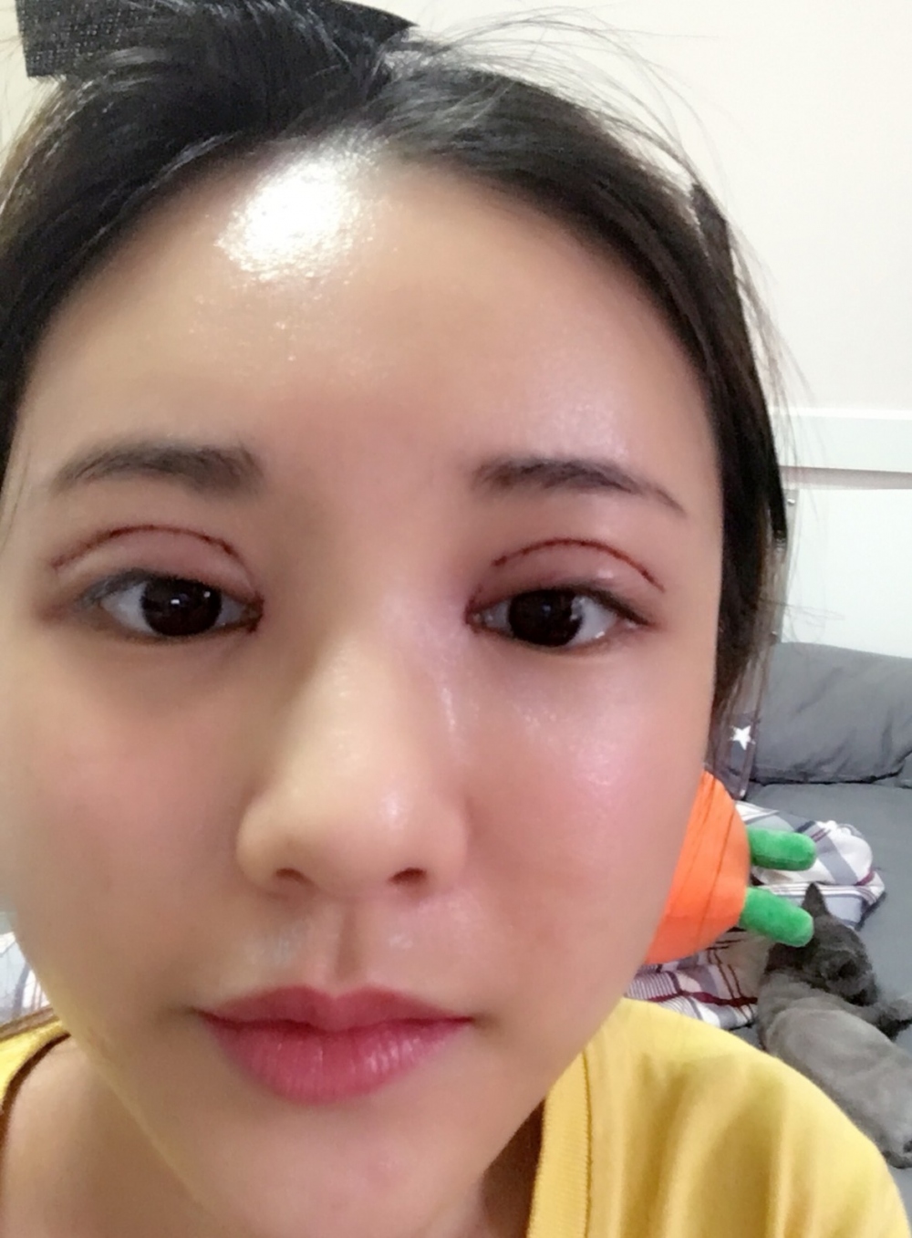 鄭州銘藝整形醫(yī)生陳濤做切開雙眼皮怎么樣？鄭州銘藝切開雙眼皮案例