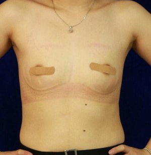 珠海萊茵醫(yī)療美容醫(yī)院崔俊溶醫(yī)生做自體脂肪隆胸效果怎么樣？附自體脂肪隆胸案例