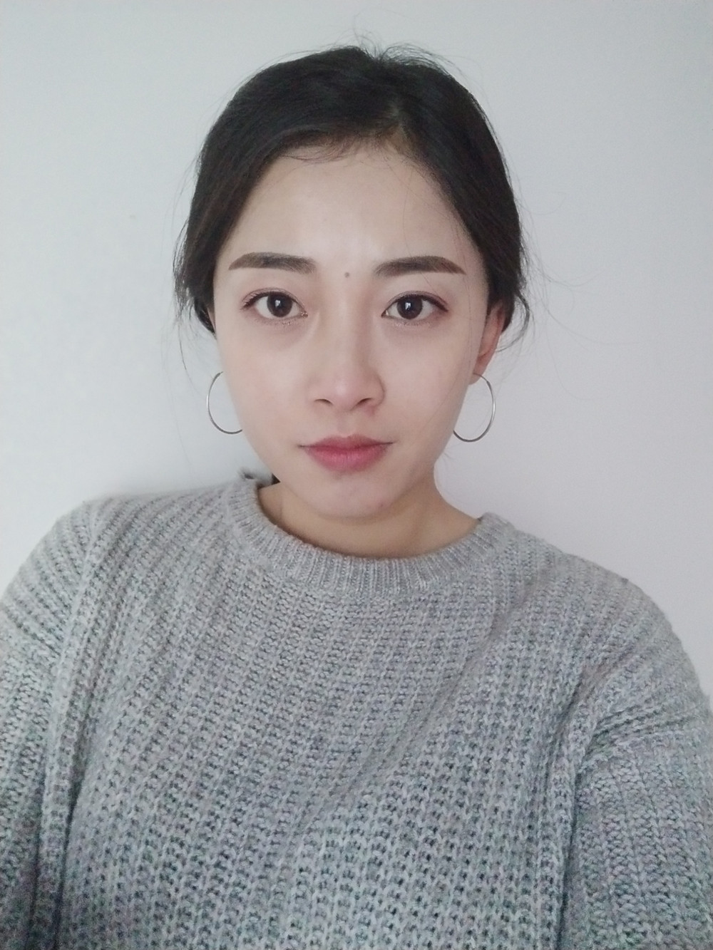 重慶當(dāng)代整形李敏旭醫(yī)生做皮秒激光祛斑效果怎么樣？附皮秒激光祛斑案例