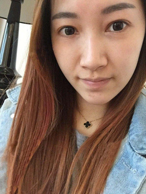 重慶五洲女子醫(yī)院整形美容中心做光子嫩膚怎么樣？淡明斌醫(yī)生光子嫩膚案例