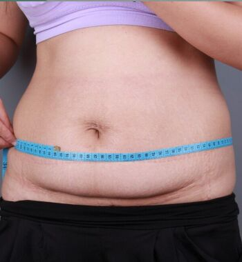 武漢東方麗人醫(yī)院整形美容科胡江偉醫(yī)生做腰腹吸脂案例效果對比圖