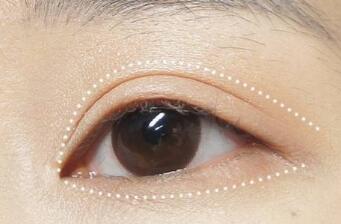 貴陽(yáng)藝齡整形割雙眼皮