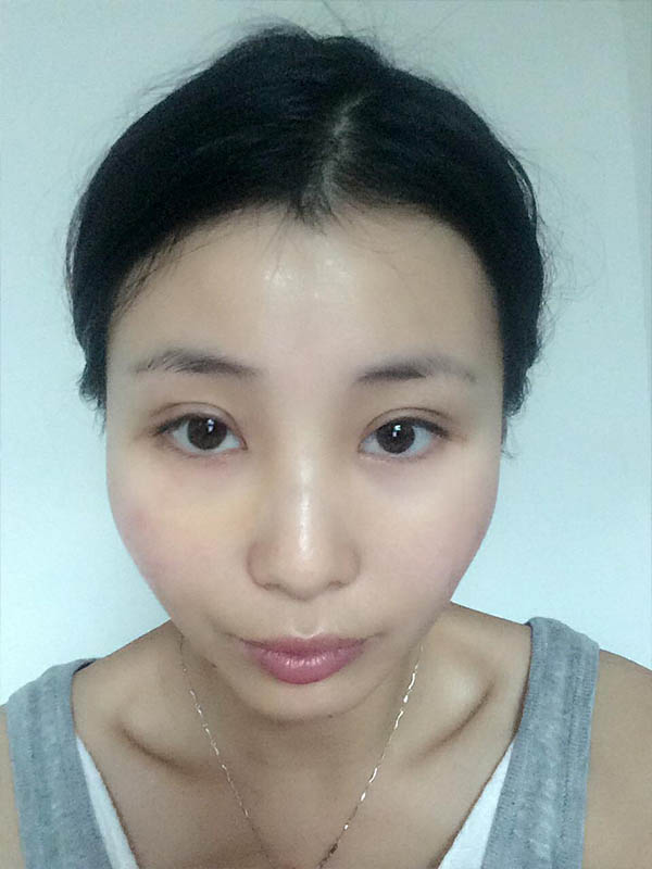 桂林新華醫(yī)療美容醫(yī)生李新華做雙眼皮手術怎么樣？李新華雙眼皮手術案例