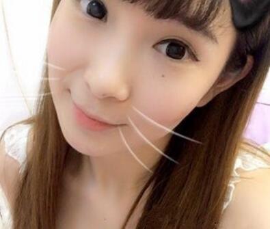 武漢中翰整形外科醫(yī)院陳志鵬醫(yī)生做雙眼皮修復(fù)效果怎么樣？附雙眼皮修復(fù)案例