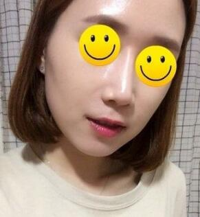 信陽(yáng)東方藝美容醫(yī)院劉力萌做玻尿酸去法令紋效果怎么樣？附案例效果對(duì)比圖