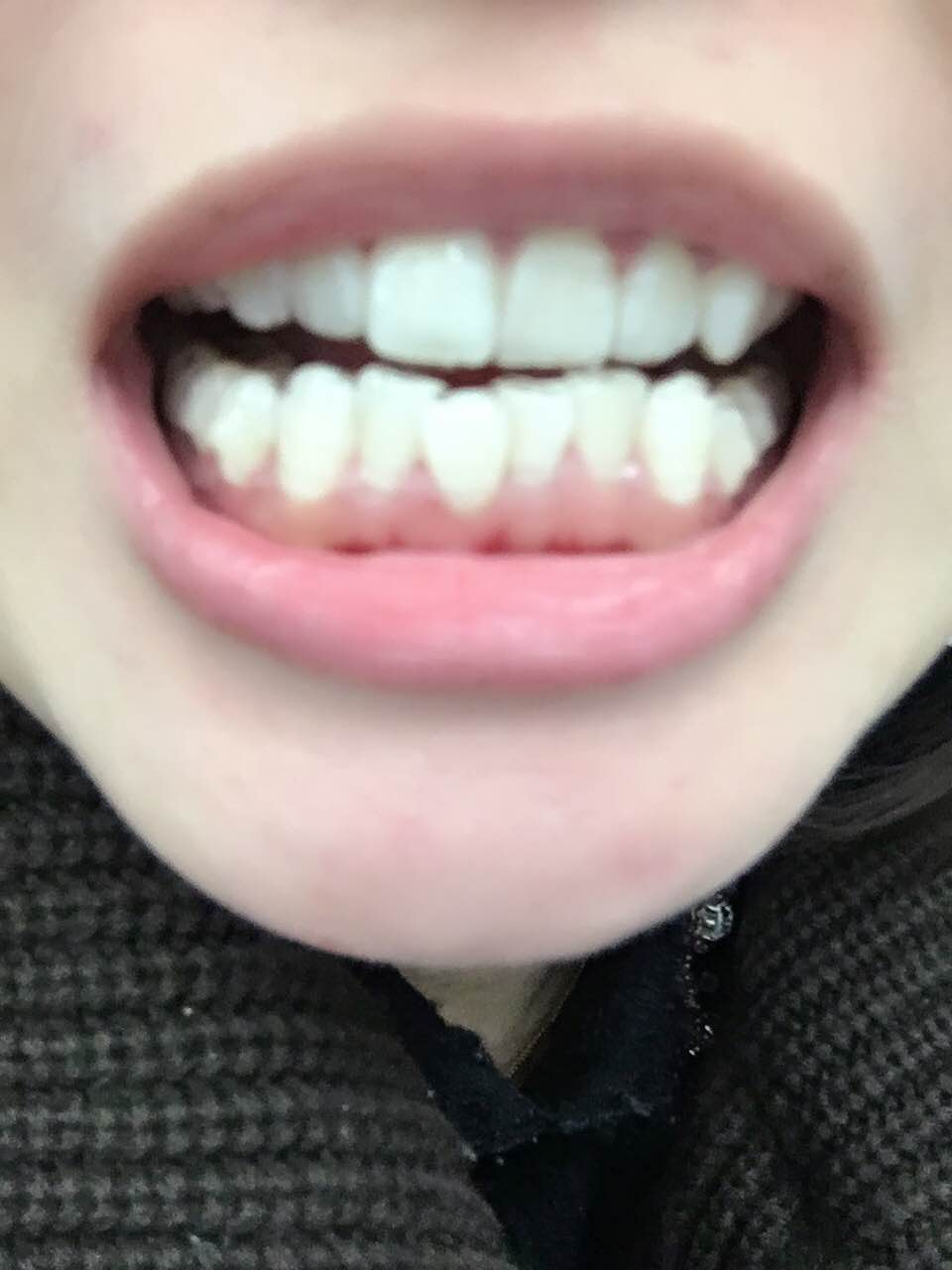 鄭州壹加壹整形醫(yī)院楊永利醫(yī)生做牙齒隱形矯正怎么樣？附牙齒隱形矯正案例