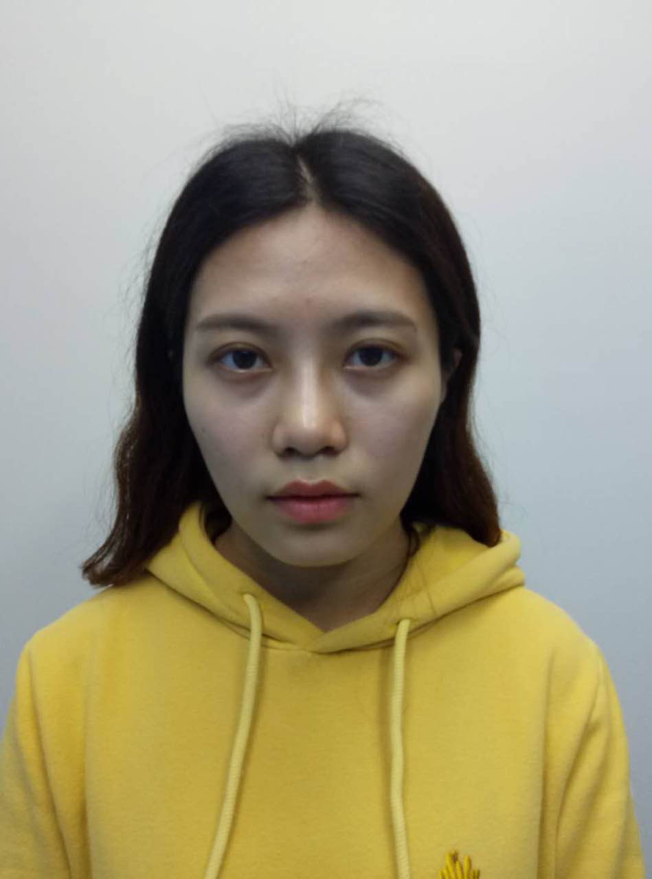 重慶美圣美邦整形醫(yī)院劉力維醫(yī)生做自體脂肪全臉填充案例效果對(duì)比圖