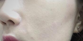 信陽(yáng)東方藝美容醫(yī)院劉力萌做玻尿酸去法令紋效果怎么樣？附案例效果對(duì)比圖