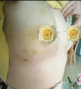 慈溪悅爾整形醫(yī)院趙天宇做自體脂肪隆胸怎么樣？附自體脂肪隆胸案例