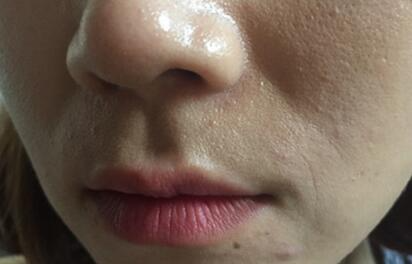 信陽(yáng)東方藝美容醫(yī)院劉力萌做玻尿酸去法令紋效果怎么樣？附案例效果對(duì)比圖