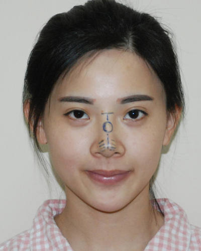 襄陽維多利亞整形醫(yī)院安邰晥醫(yī)生做鼻綜合整形怎么樣？附鼻綜合整形案例