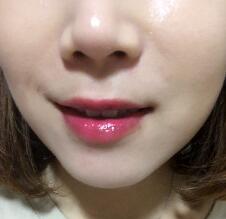 信陽(yáng)東方藝美容醫(yī)院劉力萌做玻尿酸去法令紋效果怎么樣？附案例效果對(duì)比圖