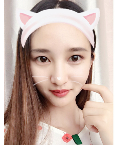 武漢維納斯整形醫(yī)院趙瑾醫(yī)生做玻尿酸墊下巴怎么樣？附玻尿酸墊下巴案例