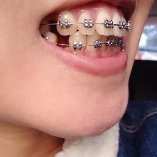 重慶嘉悅口腔醫(yī)院周繼祥醫(yī)生做金屬托槽矯正效果怎么樣？附案例效果對比圖