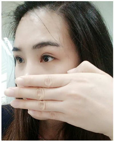 營口臻美醫(yī)療整形醫(yī)生閆迎軍做雙眼皮效果怎么樣？附雙眼皮案例對比圖