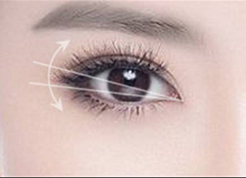 懷化華美美萊整形埋線雙眼皮