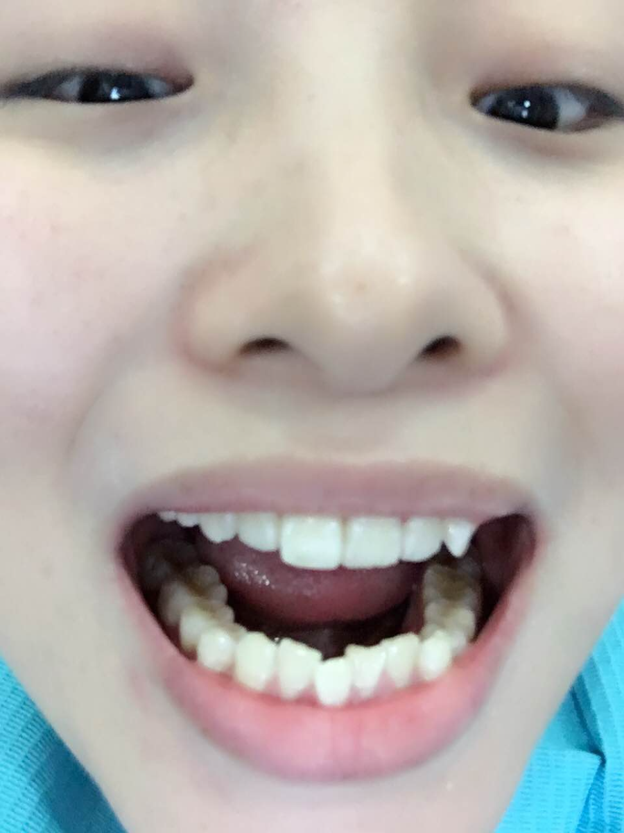 鄭州壹加壹整形醫(yī)院楊永利醫(yī)生做牙齒隱形矯正怎么樣？附牙齒隱形矯正案例