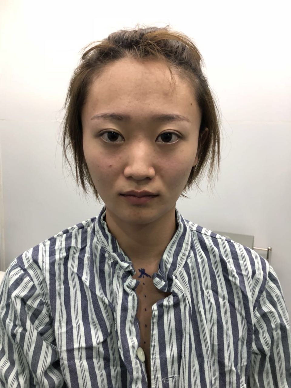 杭州迪美整形常德成醫(yī)生做鼻綜合整形技術(shù)怎么樣？附鼻綜合整形案例