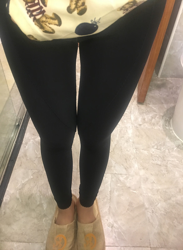 晉城鳳凰整形美容醫(yī)院宋發(fā)興醫(yī)生做大腿吸脂怎么樣？附大腿吸脂案例