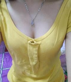 慈溪悅爾整形醫(yī)院趙天宇做自體脂肪隆胸怎么樣？附自體脂肪隆胸案例