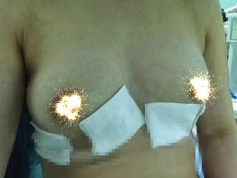 慈溪悅爾整形醫(yī)院趙天宇做自體脂肪隆胸怎么樣？附自體脂肪隆胸案例