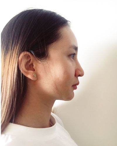 武漢維納斯整形醫(yī)院趙瑾醫(yī)生做玻尿酸墊下巴怎么樣？附玻尿酸墊下巴案例