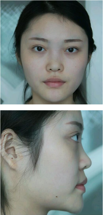 武漢維納斯整形醫(yī)院韓國濤醫(yī)生做鼻綜合整形怎么樣？附鼻綜合整形案例