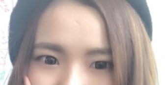 長(zhǎng)春麥西美嘉整形醫(yī)生王圣博做雙眼皮手術(shù)效果怎么樣？附雙眼皮案例