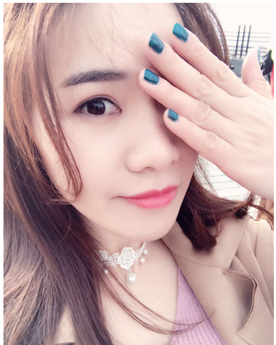 營口臻美醫(yī)療整形醫(yī)生閆迎軍做雙眼皮效果怎么樣？附雙眼皮案例對比圖