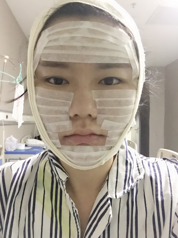 沈陽(yáng)友誼整形美容醫(yī)院金顕哲醫(yī)生做自體脂肪填充臉部+V-LINE瓜子臉手術(shù)案例效果圖 沈陽(yáng)友誼整形美容醫(yī)院金顕哲醫(yī)生做自體脂肪填充臉部+V-LINE瓜子臉手術(shù)案例效果圖