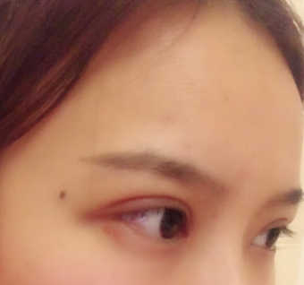 長(zhǎng)春麥西美嘉整形醫(yī)生王圣博做雙眼皮手術(shù)效果怎么樣？附雙眼皮案例