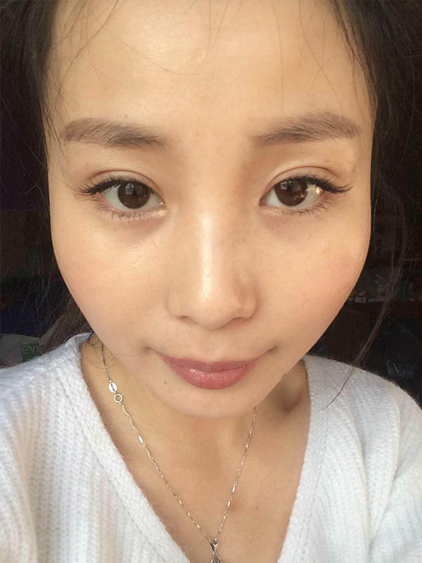 桂林新華醫(yī)療美容醫(yī)生李新華做雙眼皮手術怎么樣？李新華雙眼皮手術案例