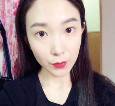 武漢中翰整形外科醫(yī)院陳志鵬醫(yī)生做雙眼皮修復(fù)效果怎么樣？附雙眼皮修復(fù)案例