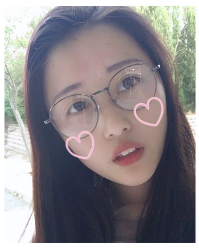 義烏傅氏口腔醫(yī)生朱雨晴做牙齒隱形矯正效果怎么樣？附牙齒隱形矯正案例